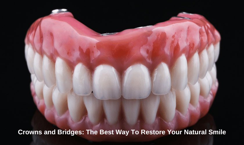Crowns and bridges
