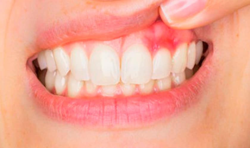 gumdisease
