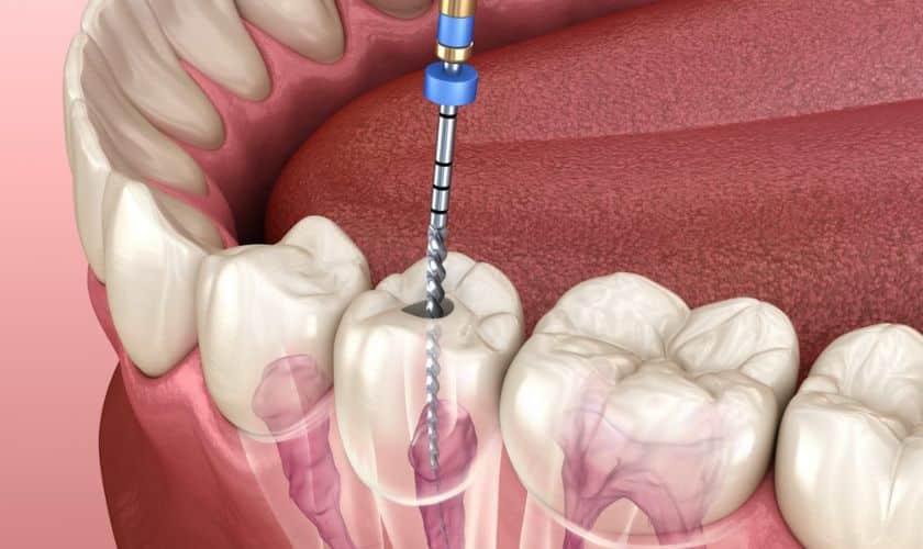 Celebrate Dental Independence: Liberating Your Smile With Root Canal Treatment!