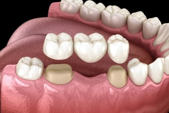 Dental crown and bridges in yorkville,IL-prairie garden dental-yorkville
