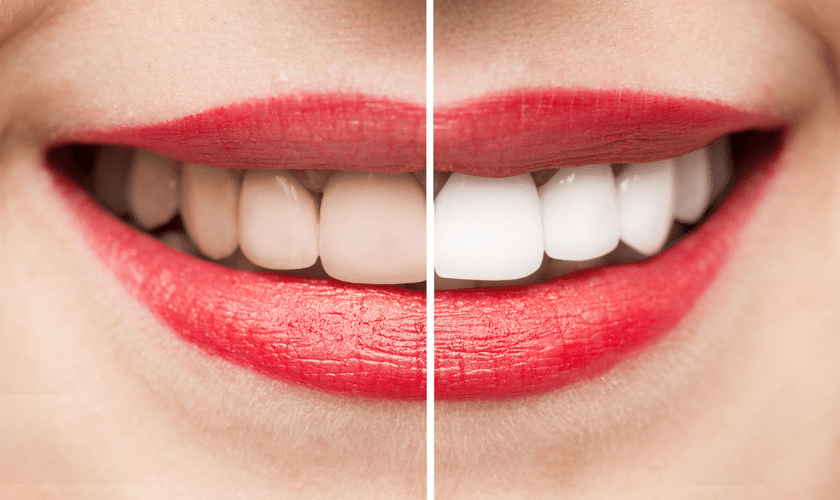 teeth whitening yorkville