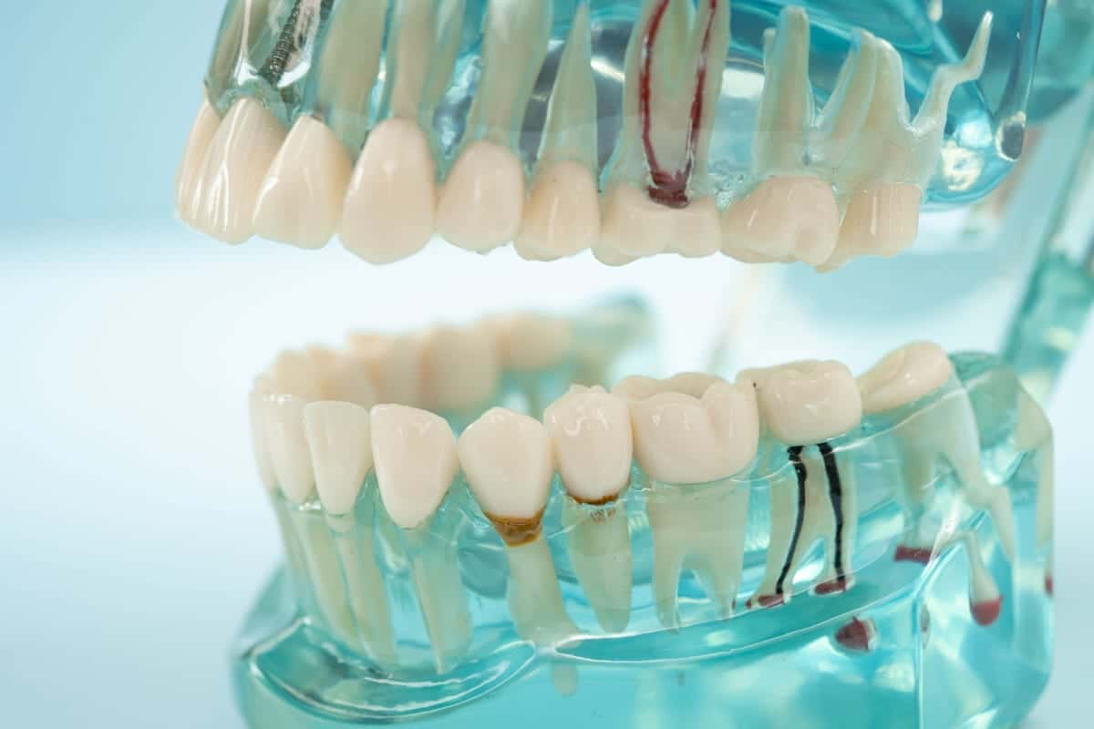 Root Canal Treatment in Yorkville