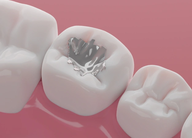 Dental Fillings at Premier Smiles of Bellevue