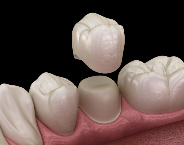 Same-day Dental Crowns Premier Smiles of Bellevue