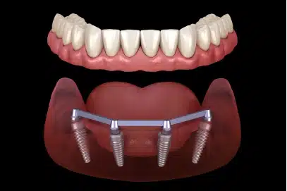 Full Mouth Dental Implants in Rocklin