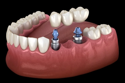 Implant-Supported Bridges