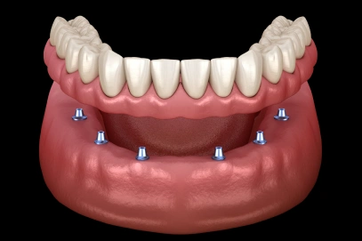 Implant-Supported Dentures