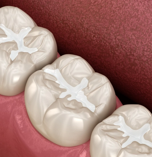 Dental sealants in Rocklin, California