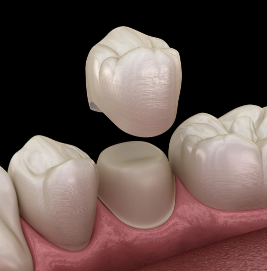 Same day crowns in Rocklin, California