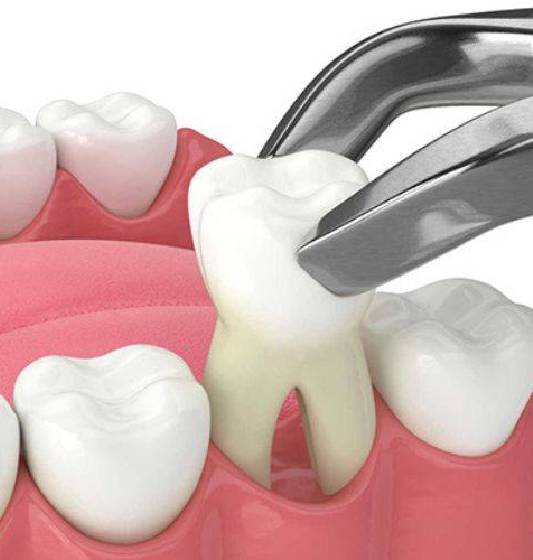 Tooth extractions in Rocklin, California