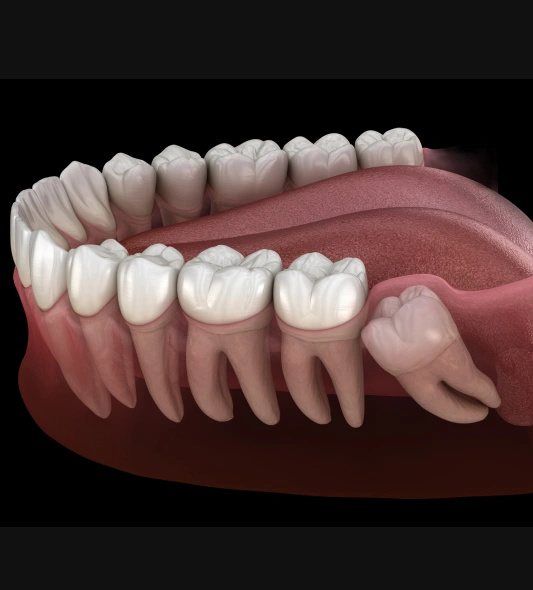 Wisdom teeth removal in Rocklin, California