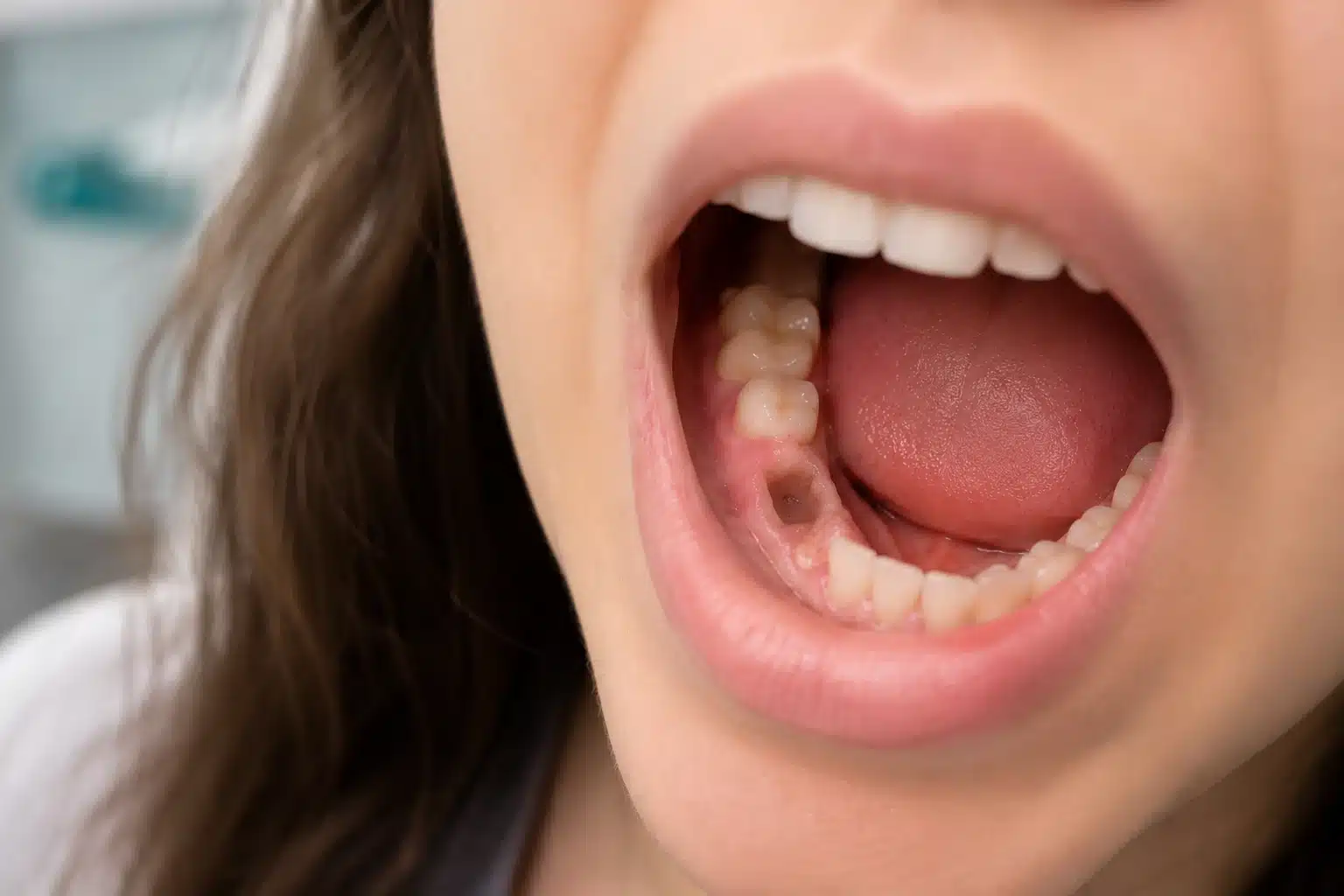 Healing normal socket after tooth extraction