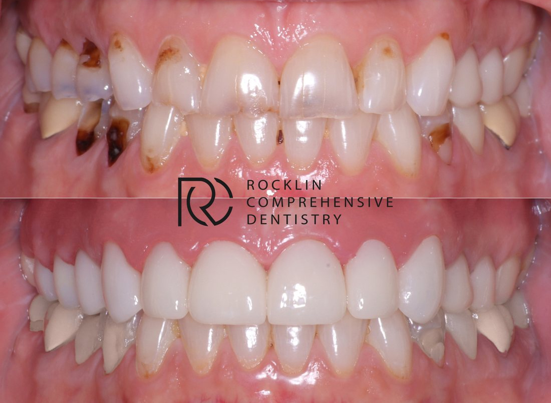 Worn, stained upper front teeth before, and an even, brighter smile after porcelain veneers