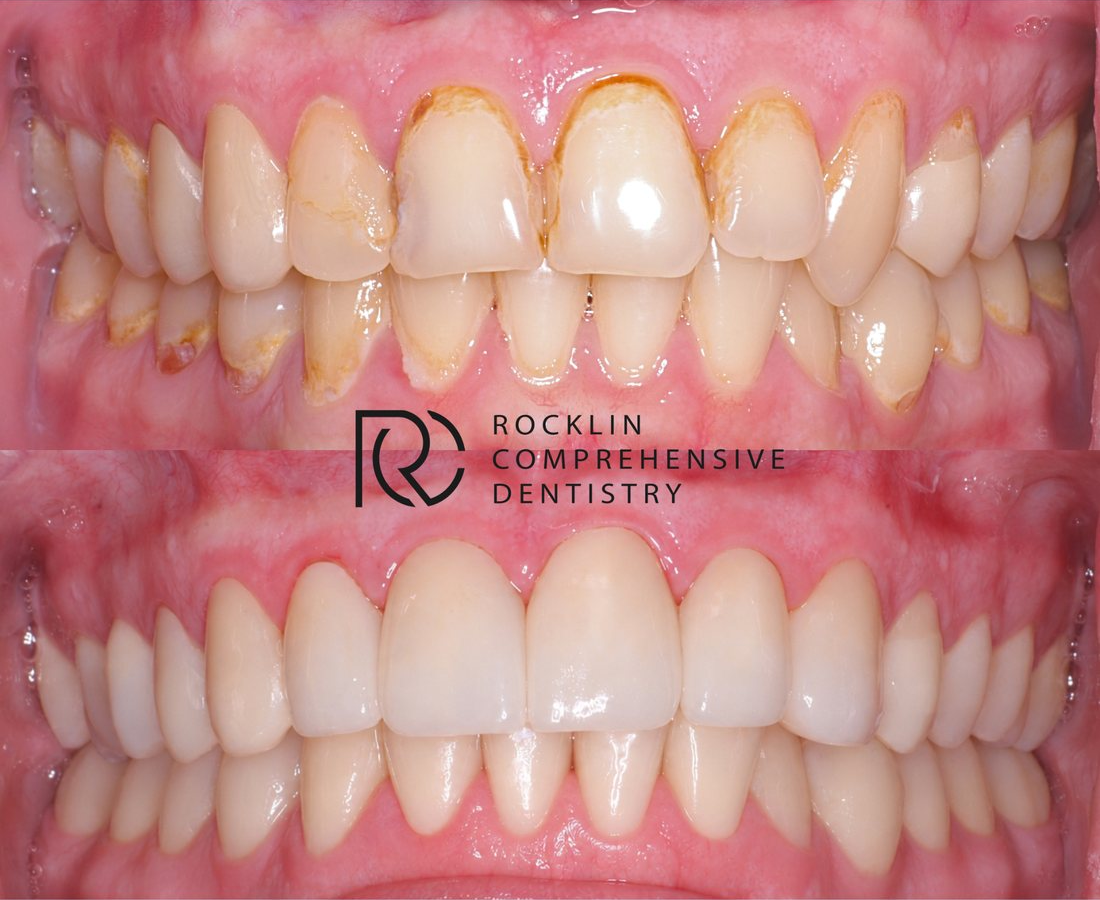 Discolored, stained teeth before, and a uniform, natural-looking smile after porcelain veneers