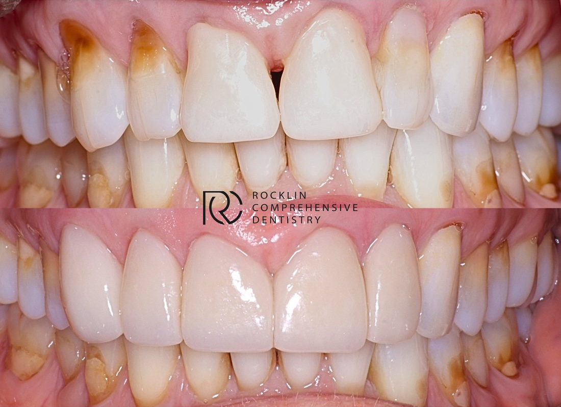 Uneven, stained front teeth with a gap before, and evenly shaped front teeth after porcelain veneers