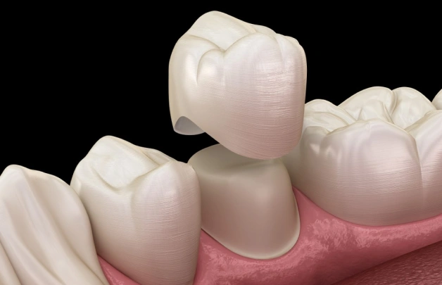 dental crowns in erdenheim
