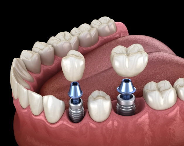 dental implants in erdenheim