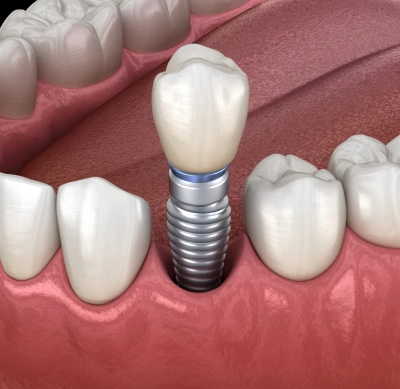 implantation in erdenheim