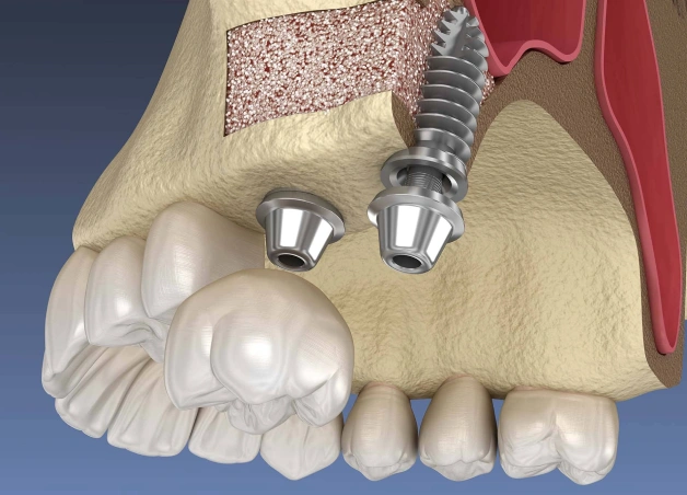 sinus lift