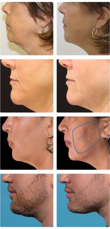 Evoke Patients
