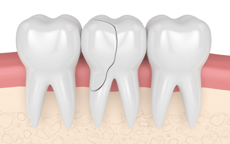 Can Root Canal Fix A Cracked Tooth?