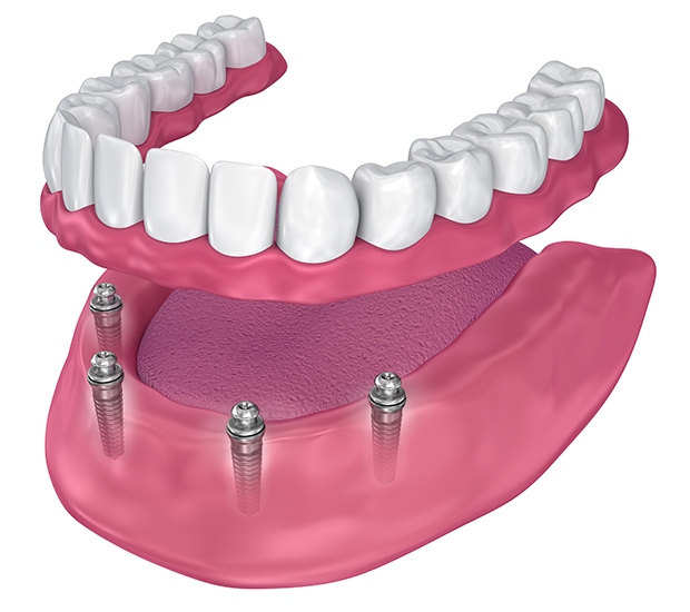 All-on-4 Implants Boca Raton