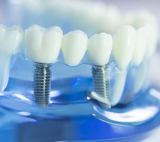 Dental Implants Boca Raton