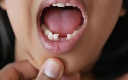 knocked out tooth how to save it before seeing a dentist