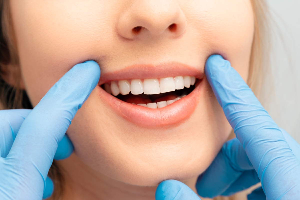 teeth-whitening-in-Rifle