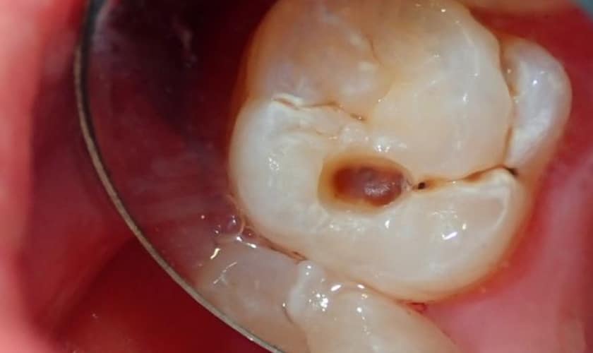 how long does it take to fix a cavity between teeth