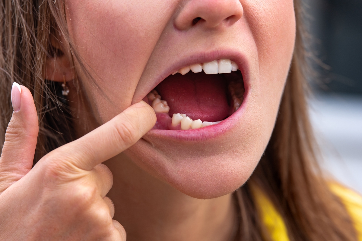 Dry Socket After Tooth Extraction