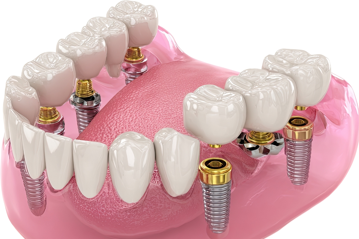 dental implants in Rockaway