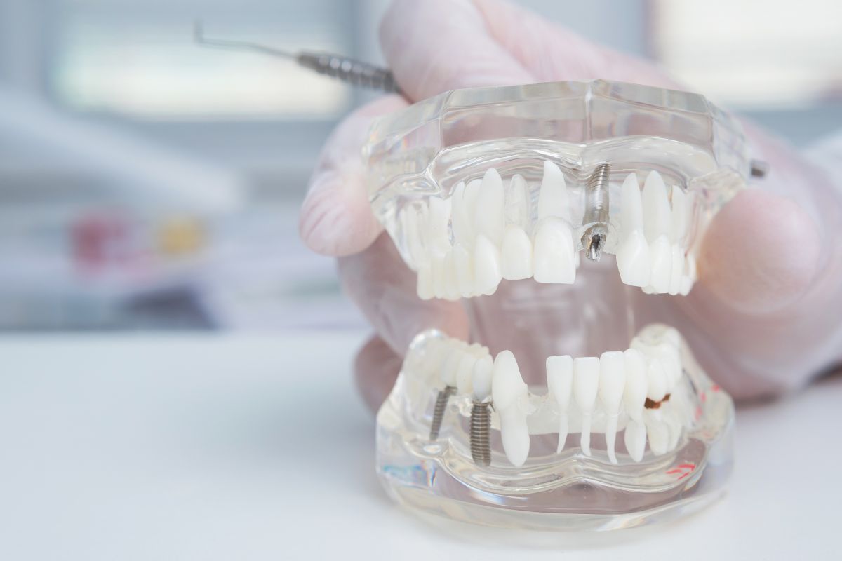 all on-4 dental implants
