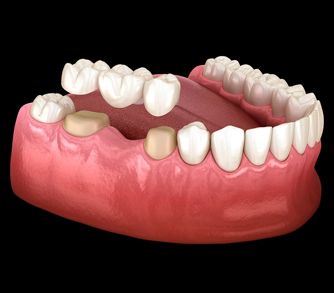 dental bridges in rockaway