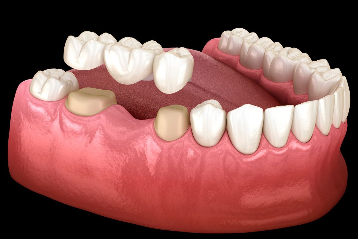 Choose the Right Restorative Treatment
