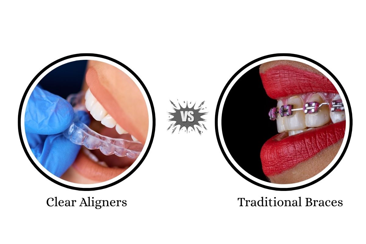 clear aligners vs traditional braces