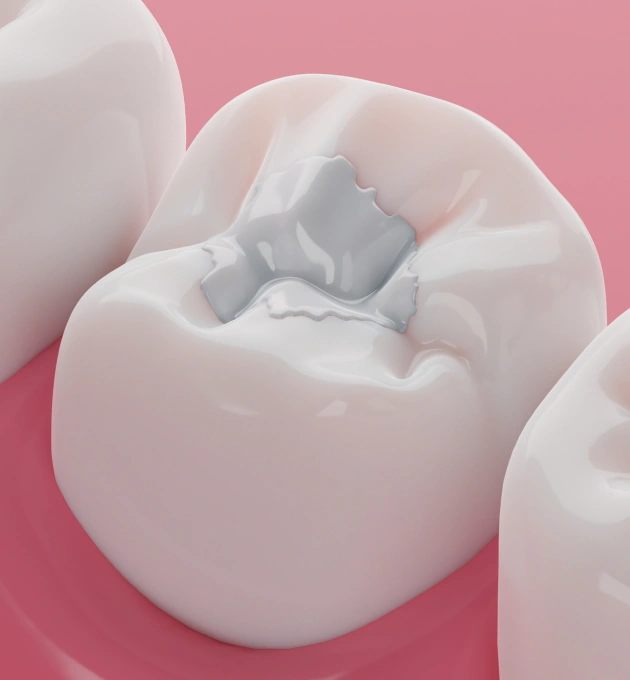 Natural-Looking Cavity Repair with Composite Fillings