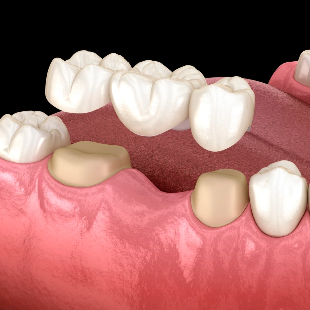 Restore Your Smile with a Custom Dental Bridge