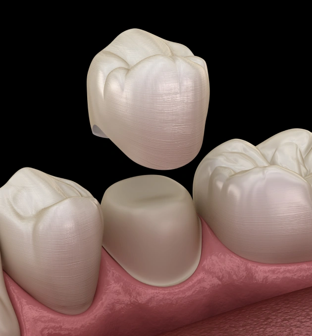 Restore Your Tooth with a Custom Dental Crown