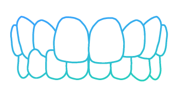 Invisalign Crossbite Teeth