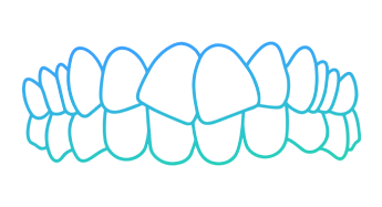 Invisalign Crowding Teeth