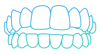 Invisalign Openbite Teeth