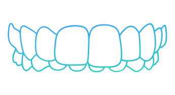 Invisalign Overbite Teeth