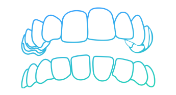 Invisalign Gapped Teeth