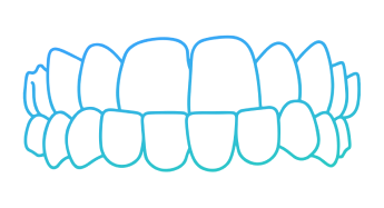 Invisalign Underbite Teeth