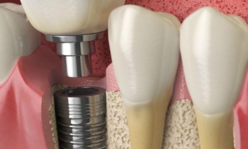 dental implants in algonquin il