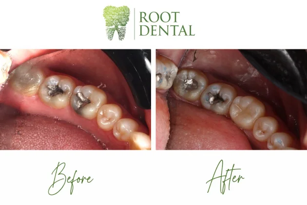 Composite filling dental treatment result   