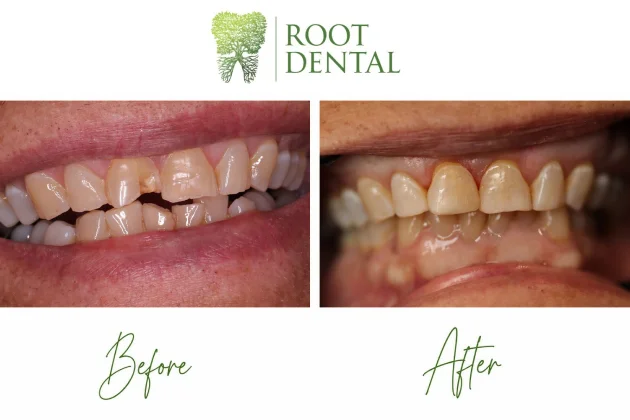 Composite restorations dental treatment result