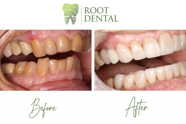 Full mouth rehabilitation dental treatment result