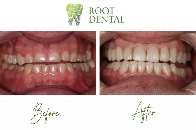 Full Mouth Rehabilitation